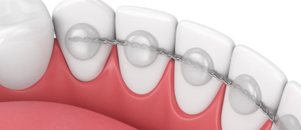 Fil de contention Fil de Contention Orthodontique Tressé | Stabilisation Dentaire